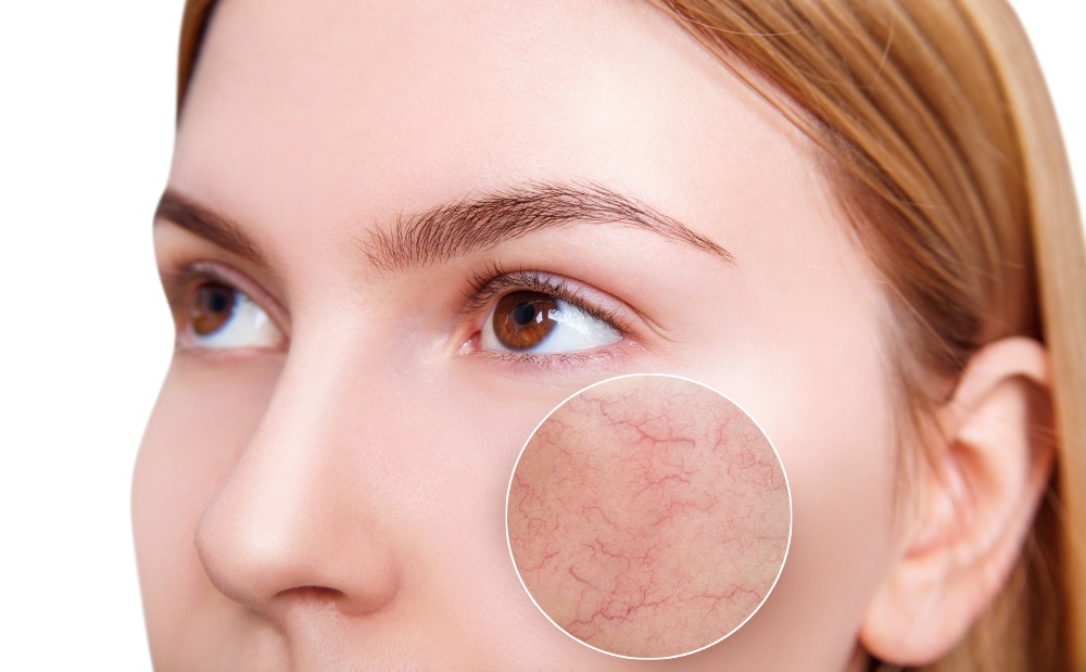 Feine, erweiterte Äderchen auf den Wangen sind typische Merkmale einer Couperose – häufig ein Frühzeichen von Rosacea Frau mit Couperose