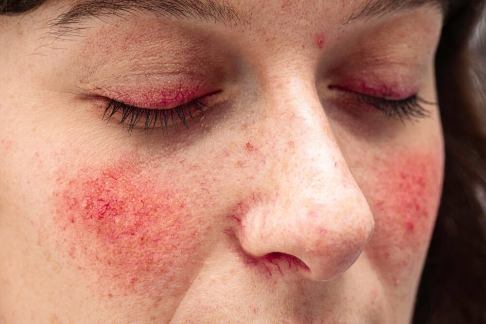 Typische Rosacea-Symptome: gerötete, empfindliche Gesichtshaut mit sichtbaren Äderchen und Hitzegefühl Frau-mit-Rosacea 2